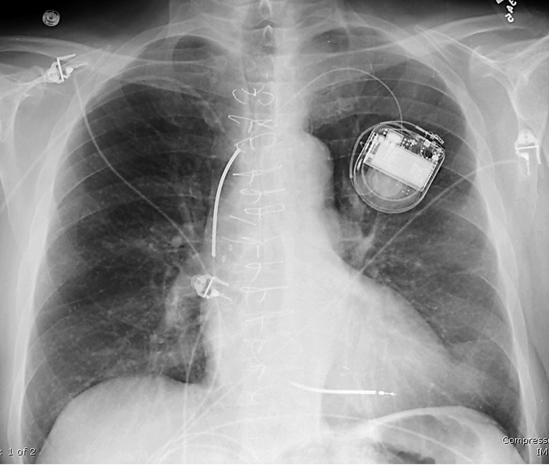 Рентгеновский снимок после установки автоматического кардиовертера-дефибриллятора