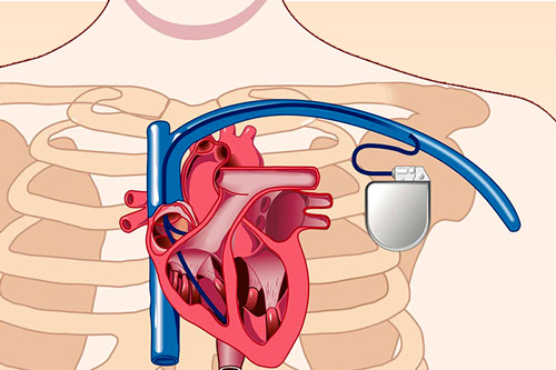 Показания к имплантации ИКД – этапы операции по установке автоматического кардиовертера-дефибриллятора