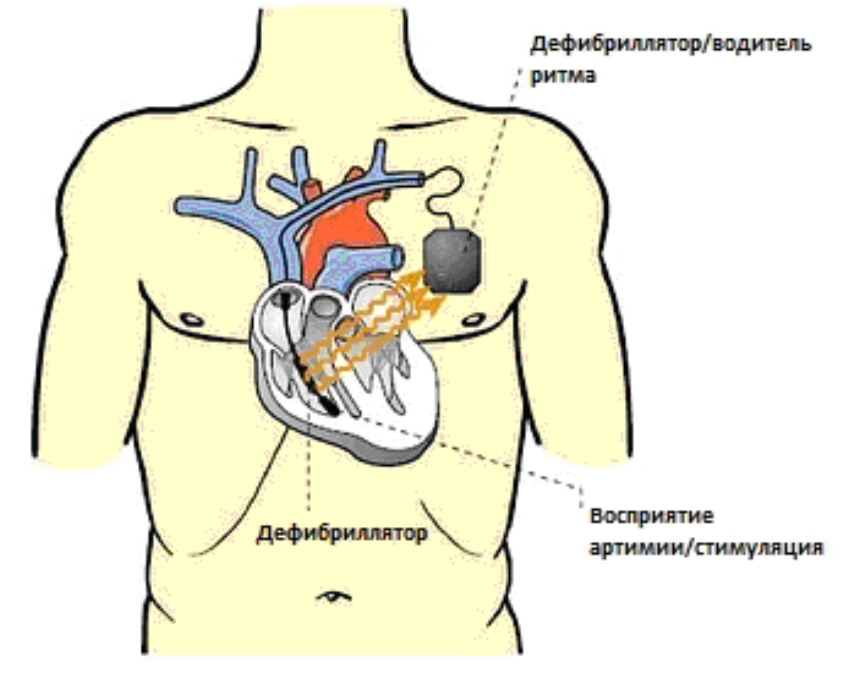 Принцип действия автоматического кардиовертера-дефибриллятора