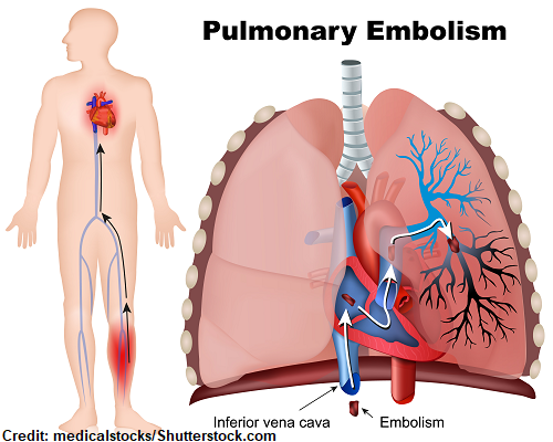 pulmonary embolism, pe, dvt, deep vein thrombosis