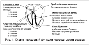 Рис. 1. Схема нарушений функции проводимости сердца