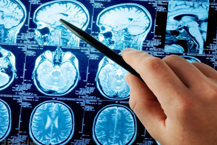 Инсульт головного мозга - одна из опаснейших патологий