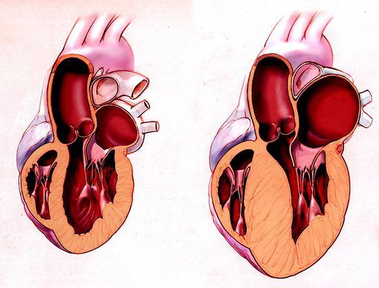 дисметаболическая кардиомиопатия