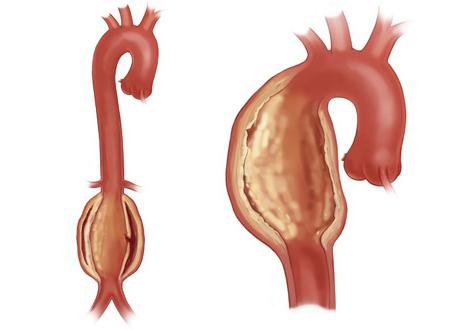 атеросклероз аорты
