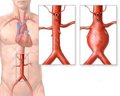 атеросклероз брюшной аорты лечение