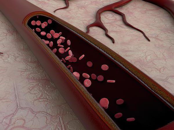 признаки гипоплазии интракраниального отдела левой позвоночной артерии 