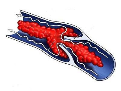 Оторвался тромб