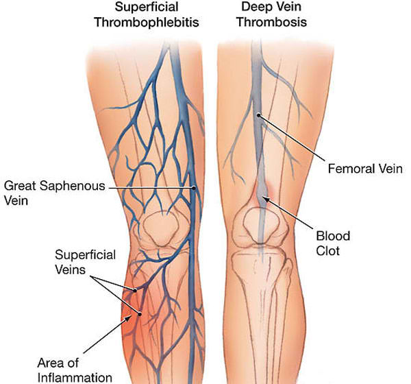 dvt deep vein thrombosis superficial
