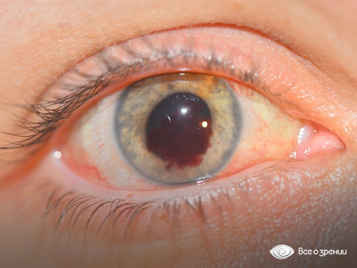 кровоизлияние в переднюю камеру глаза