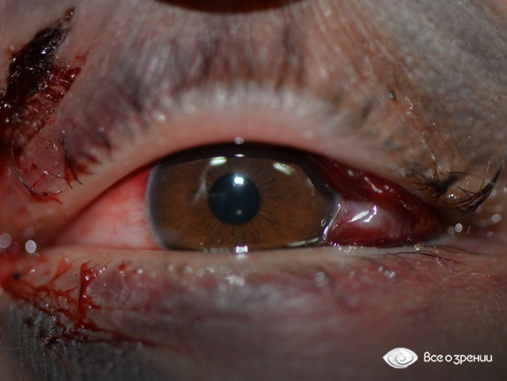 кровоизлияние в веки и глаз после травмы