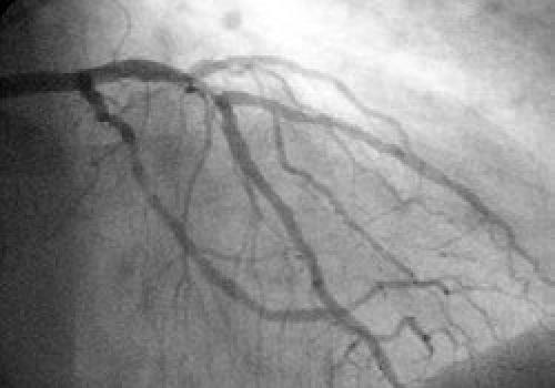Кардиоскопия сердца, как делают. Показания к диагностике 03
