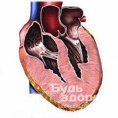 Гипертрофия правого желудочка сердца