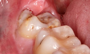 Особенности лечения кариеса зубов мудрости