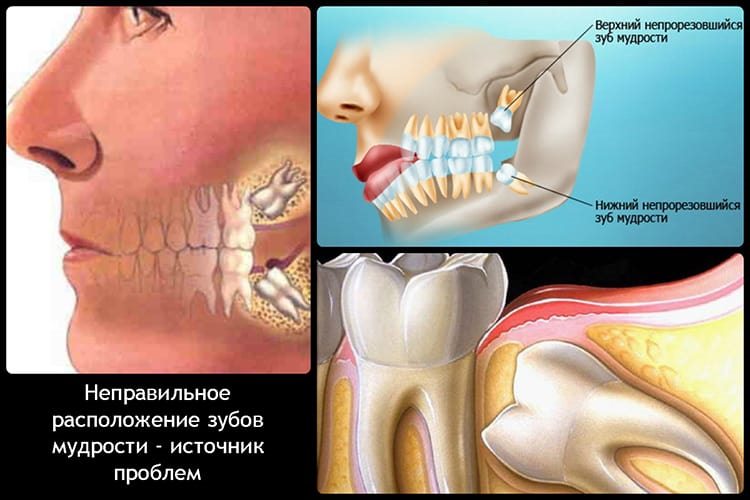 некорректное расположение зуба мудрости