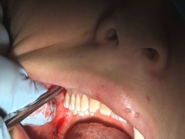 безболезненное удаление зуба