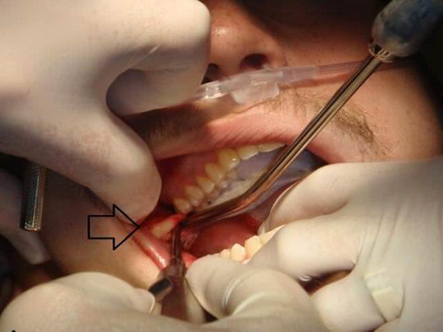 устранение зуба с верхней челюсти